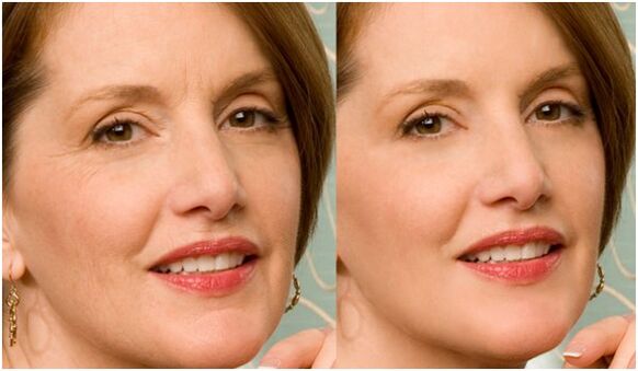 Antes y después del rejuvenecimiento facial con plasma