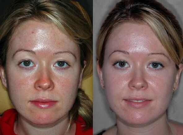 Fotos antes y después de la cirugía de rejuvenecimiento con plasma. 