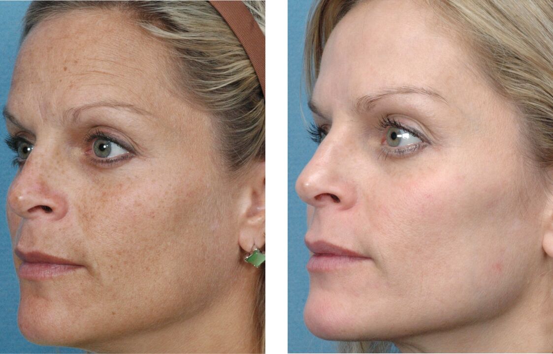 Fotos de antes y después del rejuvenecimiento de la piel 1