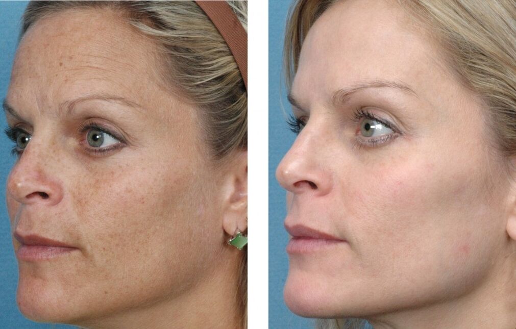 Antes y después del rejuvenecimiento de la piel. 