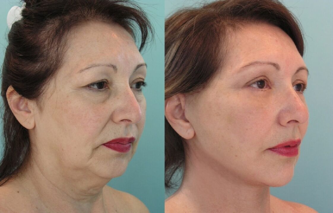 Antes y después del lifting facial con hilo
