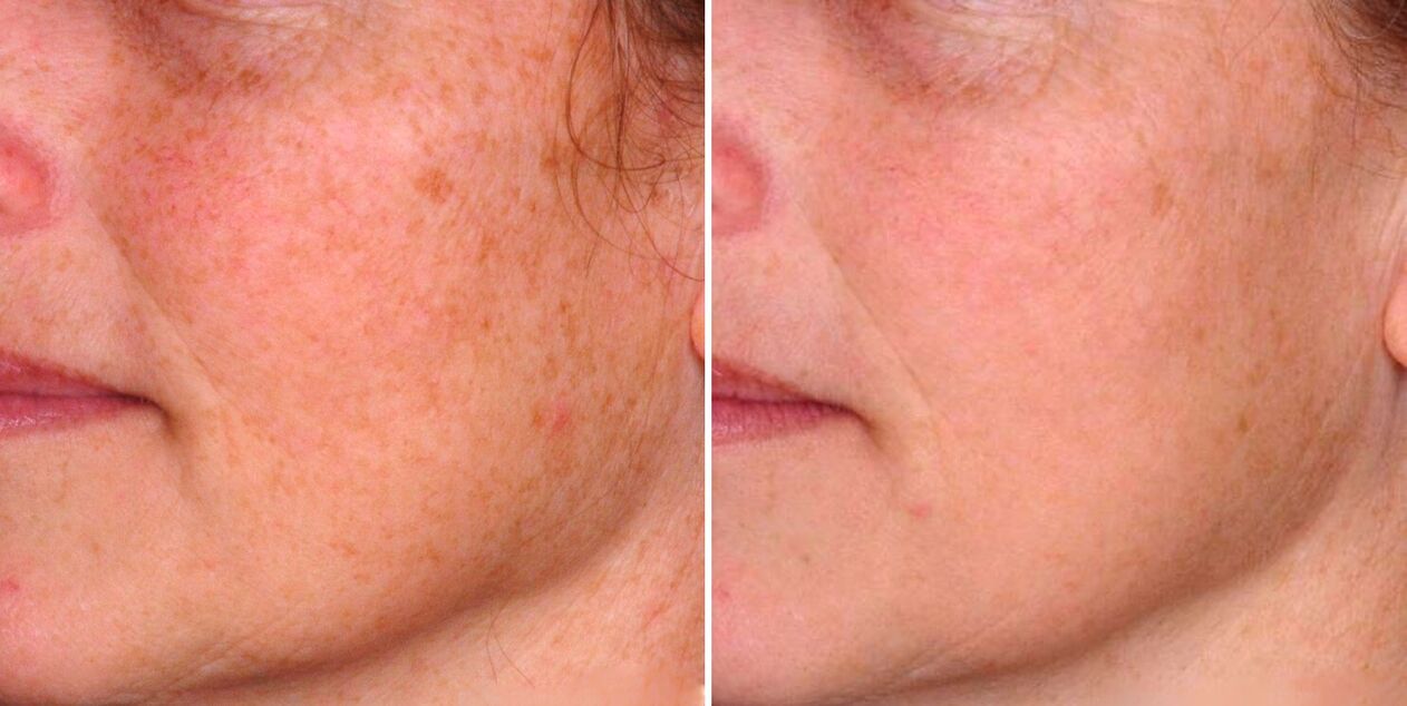 Parte del efecto fototérmico da como resultado la reducción de las manchas de la edad en la piel del rostro. 