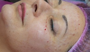 Recuperación de la piel después de la mesoterapia. 