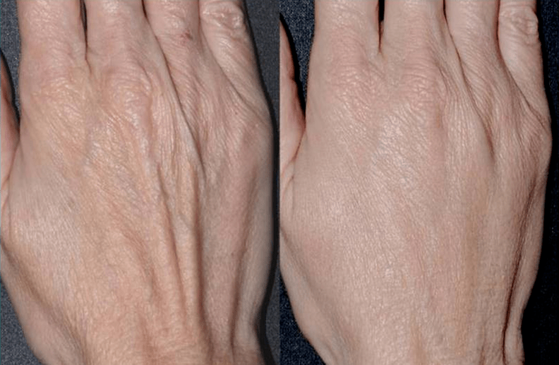 Modelado de contorno, rejuvenecimiento de manos foto 2 antes y después